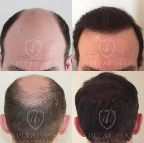 Hair Transplant experts in London UK