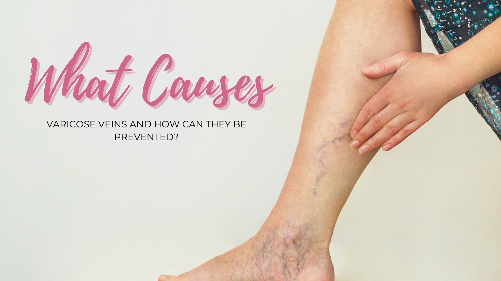 What Causes Varicose Veins and How Can They Be Prevented?